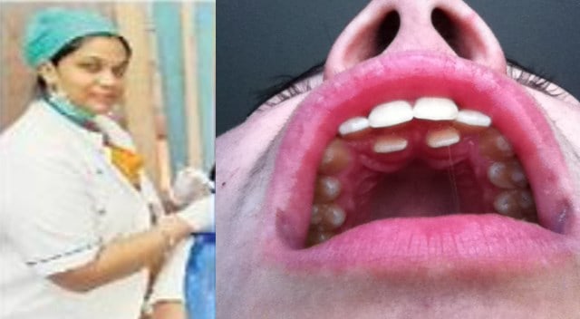50 teeth erupt in 14-year-old girl's mouth, shocked by seeing doctor