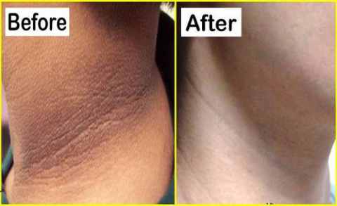 95% of people do not know these 3 best home remedies to clean black neck easily