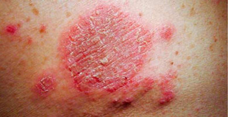 Follow these 2 easy home remedies to get rid of ringworm, itching and itching