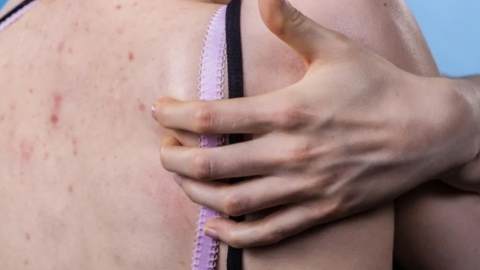 3 main causes of back acne that are important to know about