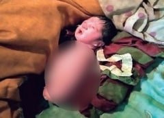 28-year-old woman gave birth to a girl without arms and legs in MP, gets such a case in lakhs